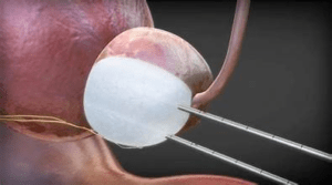 more effective and less invasive treatment for prostate cancer