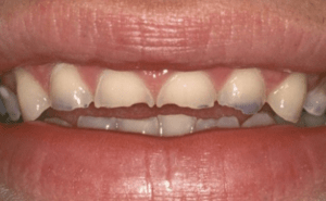 how to battle the nuisance of sensitive teeth