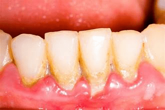 how to battle the nuisance of sensitive teeth